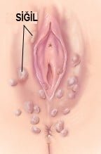 Genital Siğil - HPV - genital siğil - İstanbul Kürtaj Kliniği